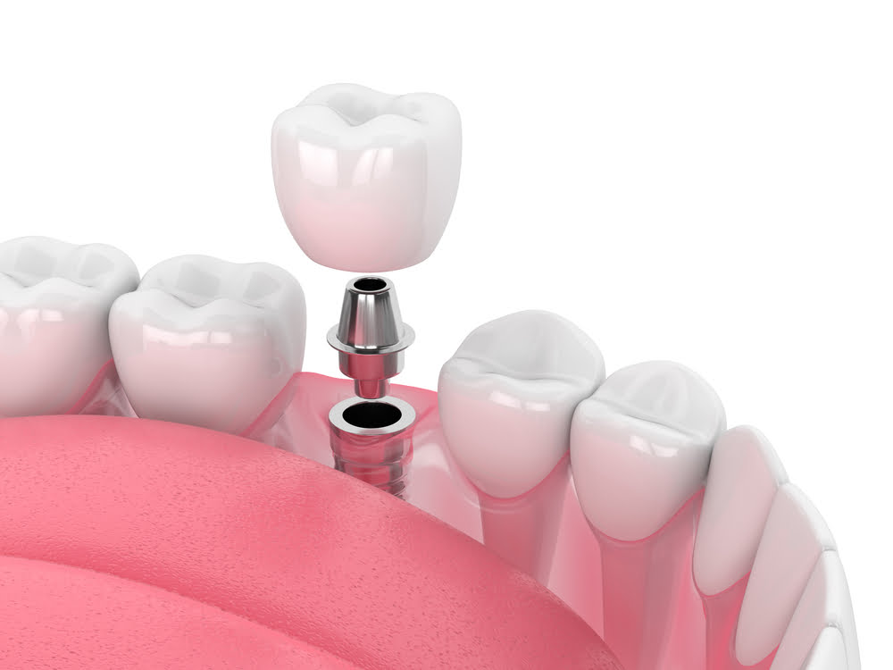 Quais os tipos de implantes dentários? 2 Depositphotos 274171808 S