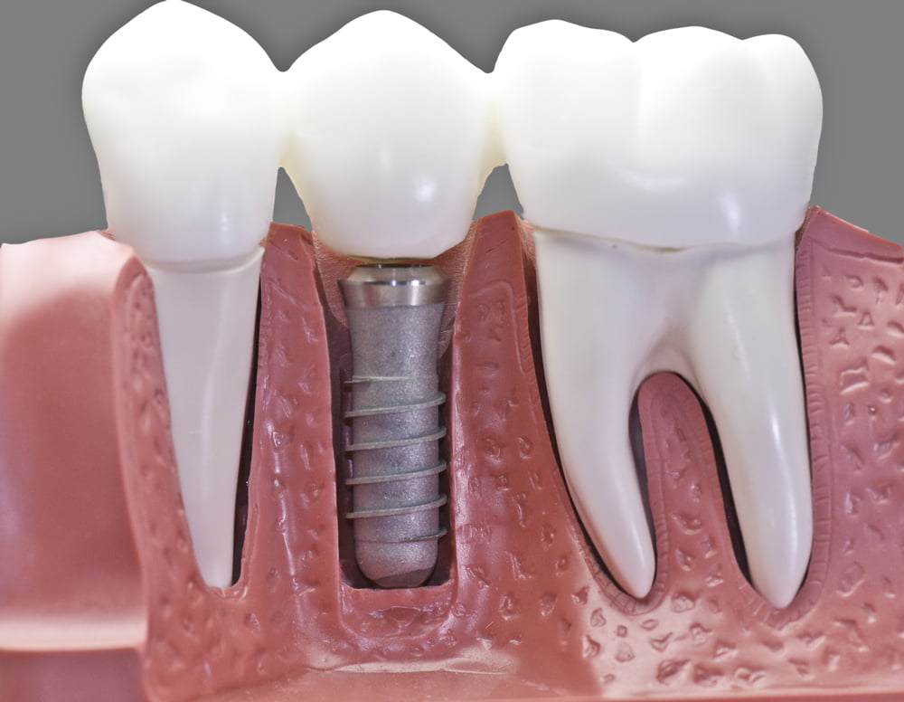 Quais os tipos de implantes dentários? 1 Depositphotos 4287971 S