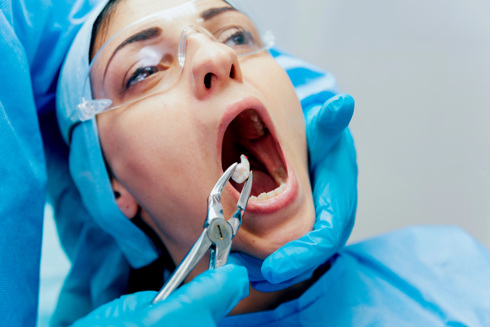 Substituir os dentes: Quais os métodos no dentista? 3 Extracao do dente siso 2